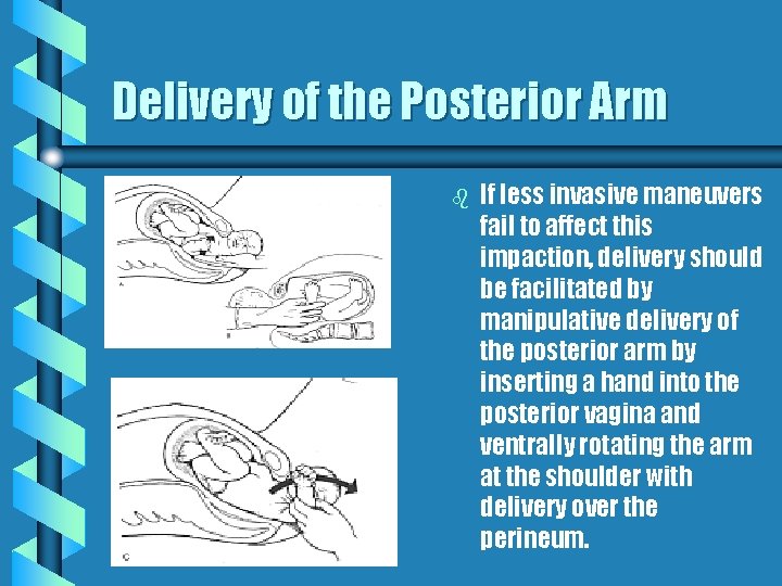 Delivery of the Posterior Arm b If less invasive maneuvers fail to affect this