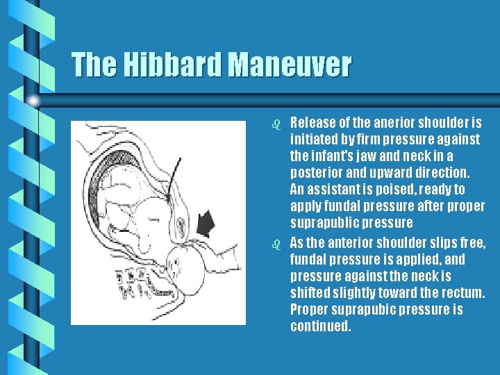 The Hibbard Maneuver b b Release of the anerior shoulder is initiated by firm