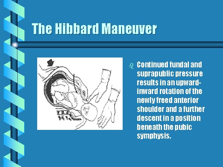 The Hibbard Maneuver b Continued fundal and suprapublic pressure results in an upwardinward rotation
