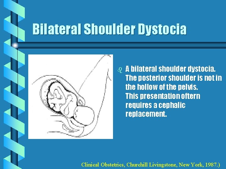 Bilateral Shoulder Dystocia b A bilateral shoulder dystocia. The posterior shoulder is not in