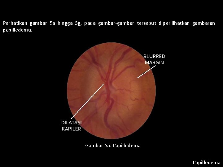 Perhatikan gambar 5 a hingga 5 g, pada gambar-gambar tersebut diperliihatkan gambaran papilledema. Gambar