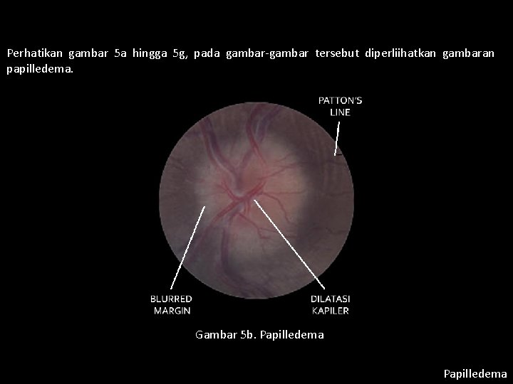 Perhatikan gambar 5 a hingga 5 g, pada gambar-gambar tersebut diperliihatkan gambaran papilledema. Gambar