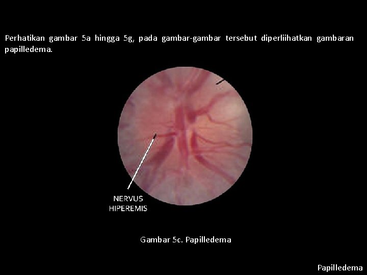 Perhatikan gambar 5 a hingga 5 g, pada gambar-gambar tersebut diperliihatkan gambaran papilledema. Gambar