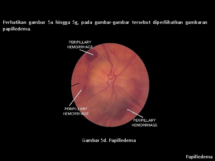 Perhatikan gambar 5 a hingga 5 g, pada gambar-gambar tersebut diperliihatkan gambaran papilledema. Gambar