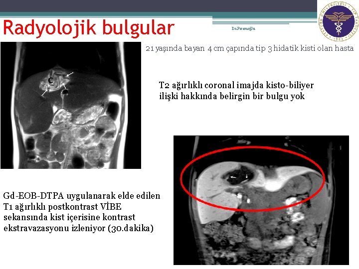 13 Radyolojik bulgular Dr. Pirimoğlu 21 yaşında bayan 4 cm çapında tip 3 hidatik