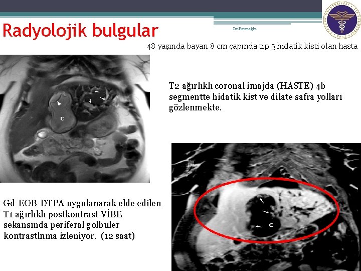 14 Radyolojik bulgular Dr. Pirimoğlu 48 yaşında bayan 8 cm çapında tip 3 hidatik