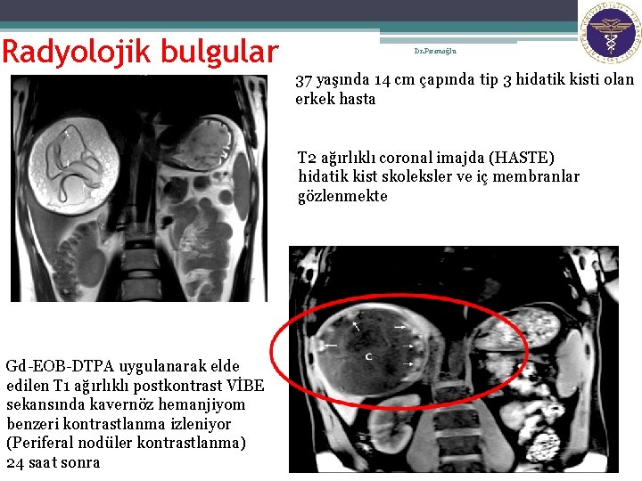 15 Radyolojik bulgular Dr. Pirimoğlu 37 yaşında 14 cm çapında tip 3 hidatik kisti