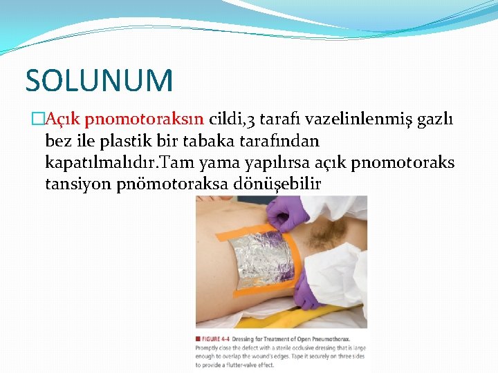 SOLUNUM �Açık pnomotoraksın cildi, 3 tarafı vazelinlenmiş gazlı bez ile plastik bir tabaka tarafından