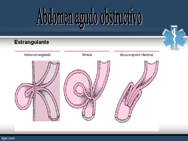 Estrangulante 