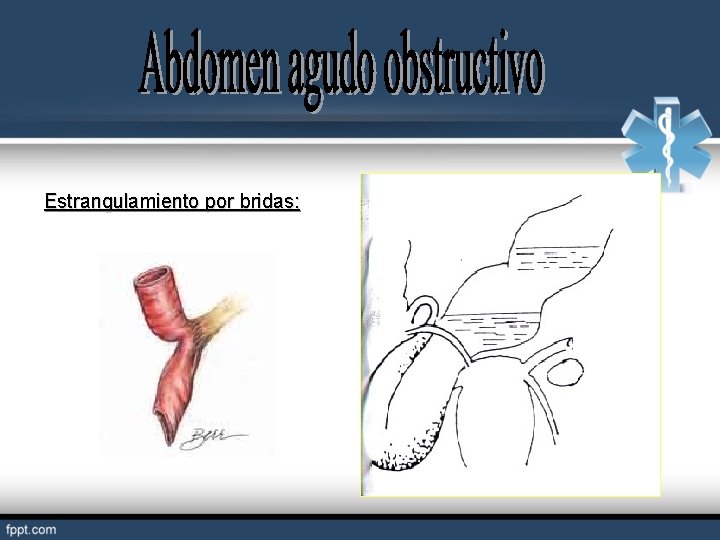Estrangulamiento por bridas: 