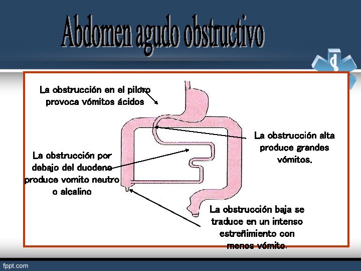 La obstrucción en el piloro provoca vómitos ácidos La obstrucción por debajo del duodeno