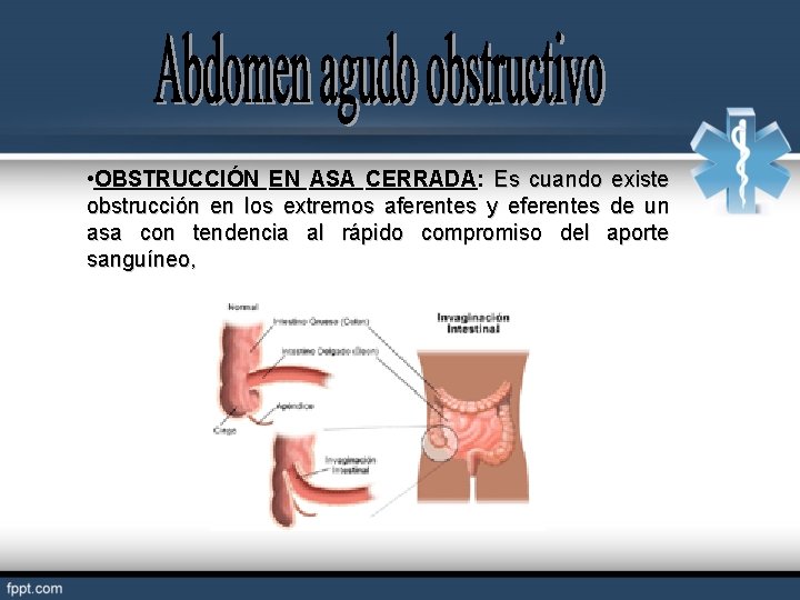  • OBSTRUCCIÓN EN ASA CERRADA: Es cuando existe obstrucción en los extremos aferentes