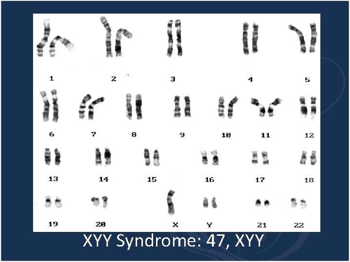 XYY Syndrome: 47, XYY 