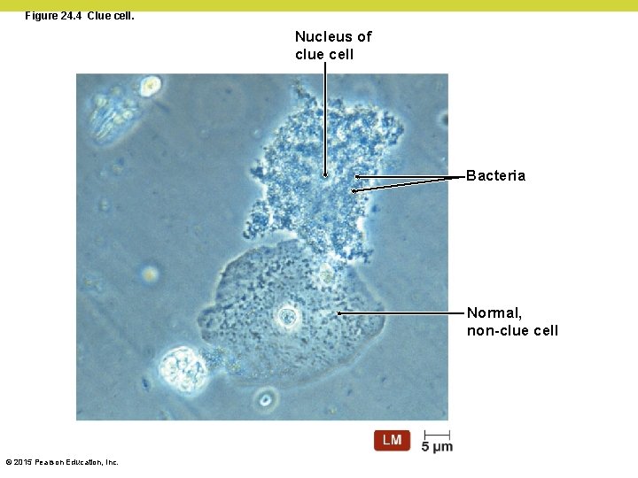Figure 24. 4 Clue cell. Nucleus of clue cell Bacteria Normal, non-clue cell ©