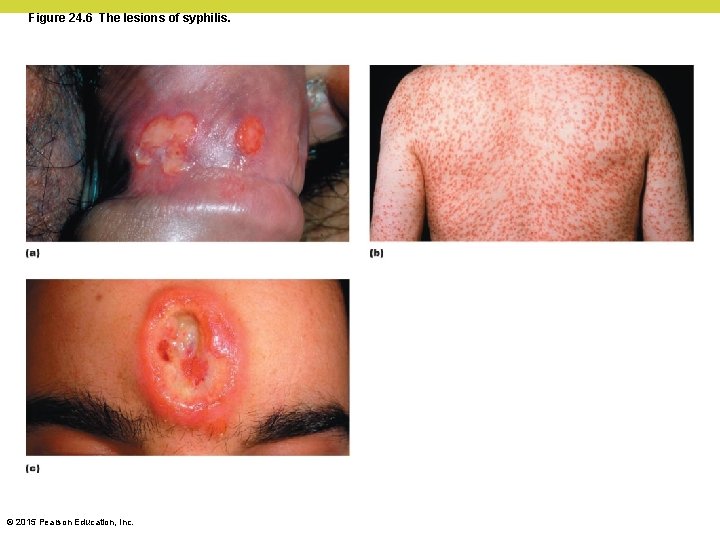 Figure 24. 6 The lesions of syphilis. © 2015 Pearson Education, Inc. 