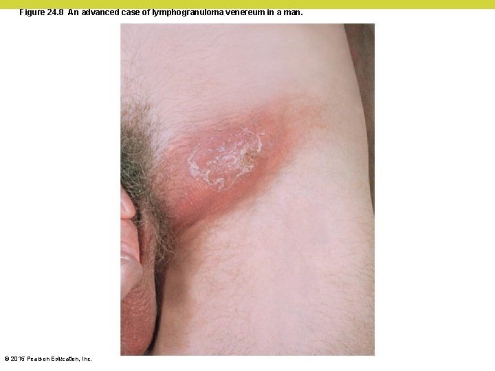 Figure 24. 8 An advanced case of lymphogranuloma venereum in a man. © 2015
