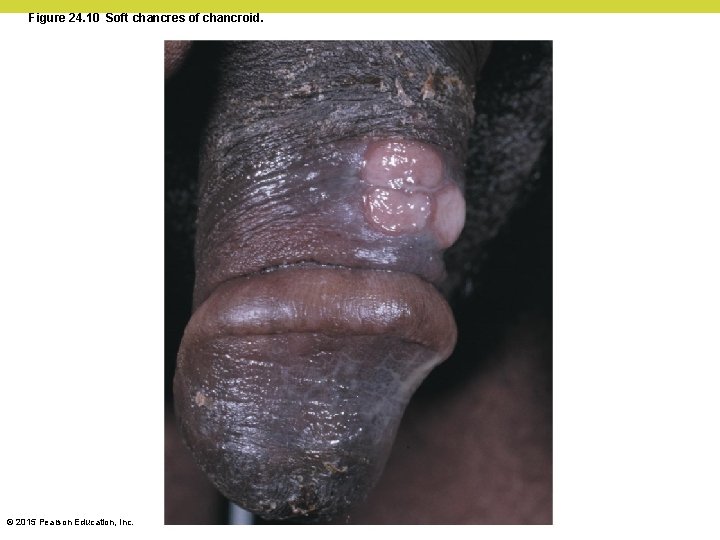 Figure 24. 10 Soft chancres of chancroid. © 2015 Pearson Education, Inc. 