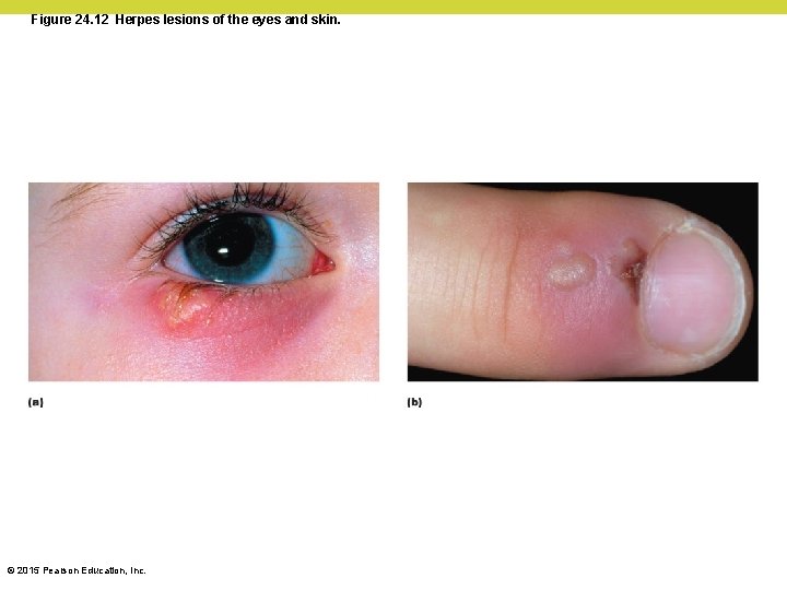 Figure 24. 12 Herpes lesions of the eyes and skin. © 2015 Pearson Education,