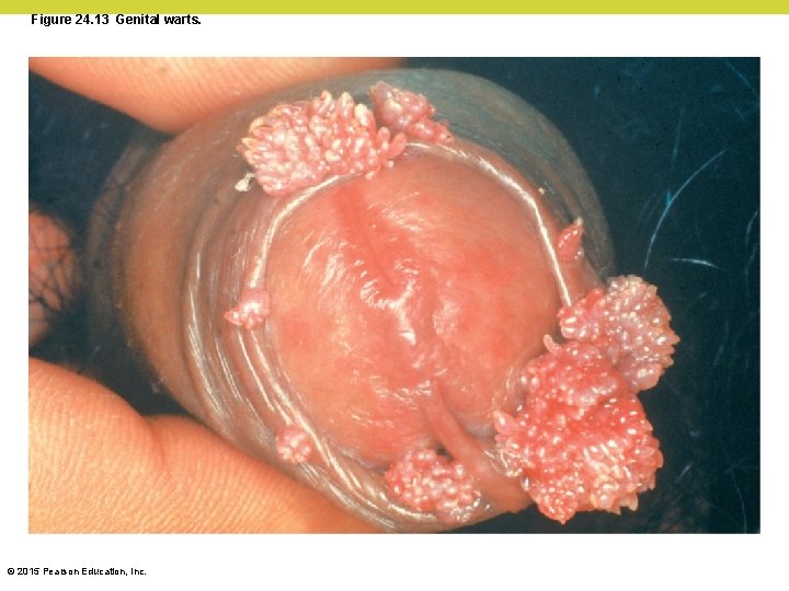 Figure 24. 13 Genital warts. © 2015 Pearson Education, Inc. 