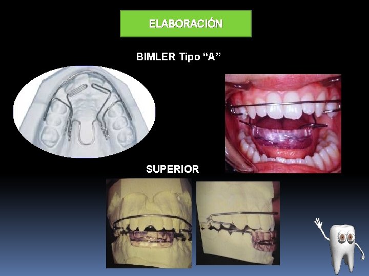 ELABORACIÓN BIMLER Tipo “A” SUPERIOR 