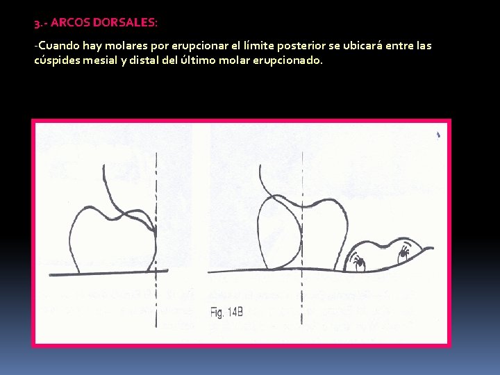 3. - ARCOS DORSALES: -Cuando hay molares por erupcionar el límite posterior se ubicará