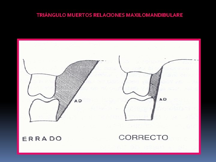 TRIÁNGULO MUERTOS RELACIONES MAXILOMANDIBULARE 