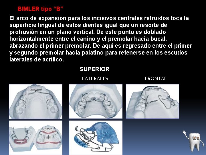 BIMLER tipo “B” El arco de expansión para los incisivos centrales retruídos toca la