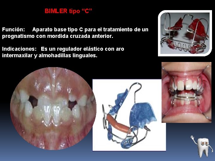 BIMLER tipo “C” Función: Aparato base tipo C para el tratamiento de un prognatismo