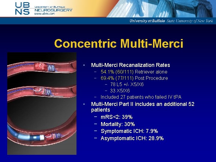 Concentric Multi-Merci • Multi-Merci Recanalization Rates − 54. 1% (60/111) Retriever alone − 69.