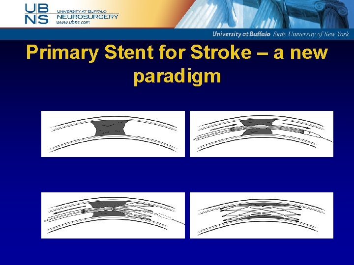Primary Stent for Stroke – a new paradigm 