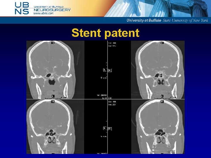 Stent patent 
