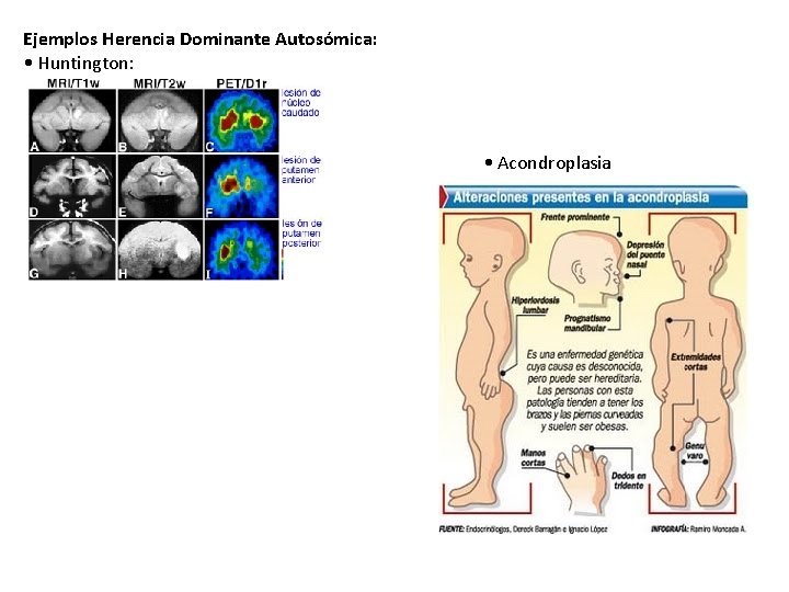 Ejemplos Herencia Dominante Autosómica: • Huntington: • Acondroplasia 
