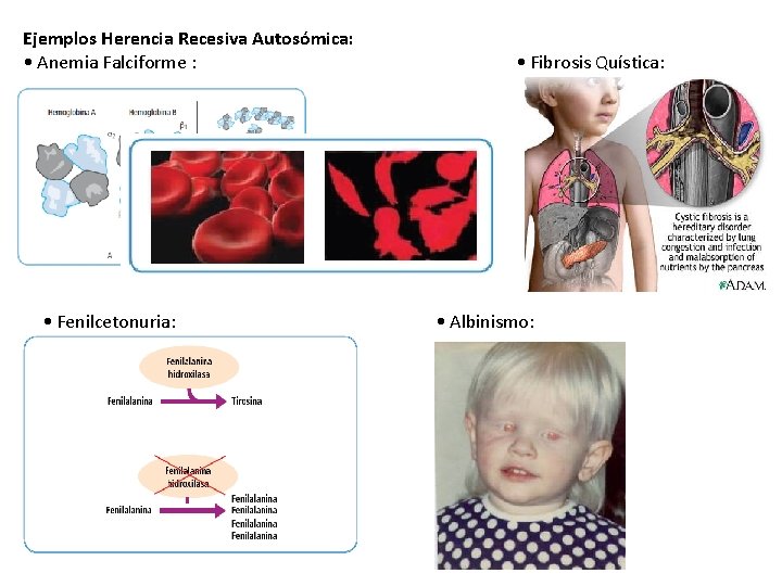 Ejemplos Herencia Recesiva Autosómica: • Anemia Falciforme : • Fenilcetonuria: • Fibrosis Quística: •