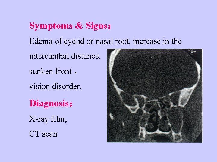Symptoms & Signs： Edema of eyelid or nasal root, increase in the intercanthal distance.