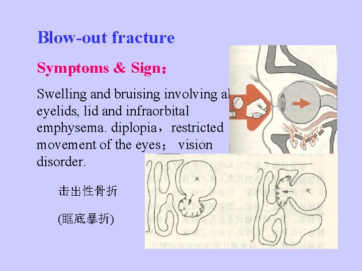 Blow-out fracture Symptoms & Sign： Swelling and bruising involving all eyelids, lid and infraorbital