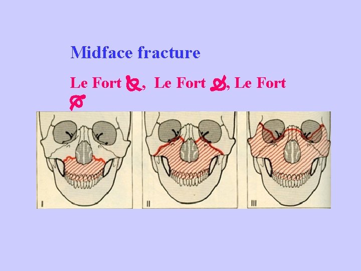 Midface fracture Le Fort , Le Fort 