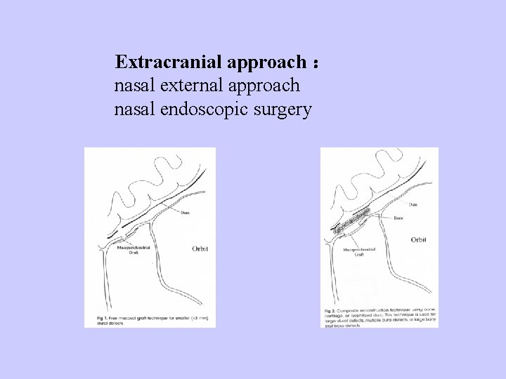 Extracranial approach ： nasal external approach nasal endoscopic surgery 