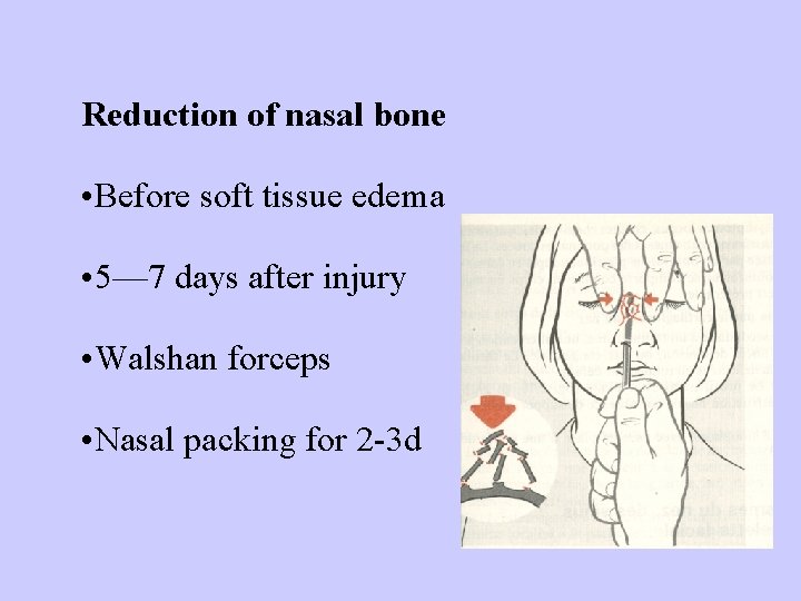 Reduction of nasal bone • Before soft tissue edema • 5— 7 days after