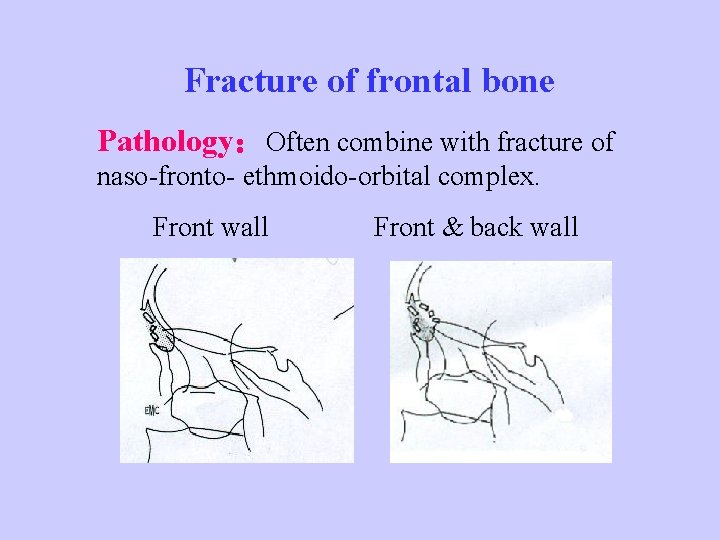 Fracture of frontal bone Pathology：Often combine with fracture of naso-fronto- ethmoido-orbital complex. Front wall