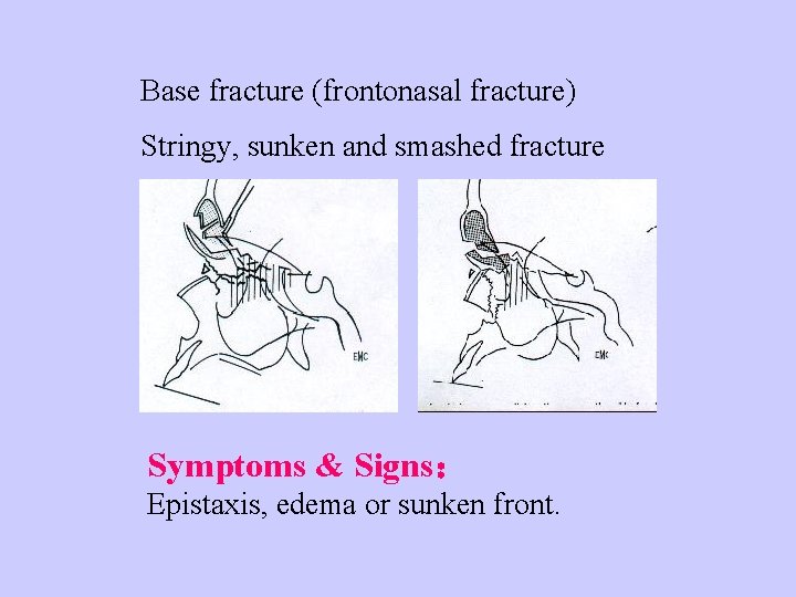 Base fracture (frontonasal fracture) Stringy, sunken and smashed fracture Symptoms & Signs： Epistaxis, edema