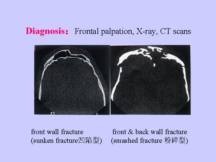 Diagnosis：Frontal palpation, X-ray, CT scans front wall fracture (sunken fracture凹陷型) front & back wall