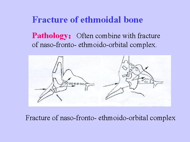 Fracture of ethmoidal bone Pathology：Often combine with fracture of naso-fronto- ethmoido-orbital complex. Fracture of