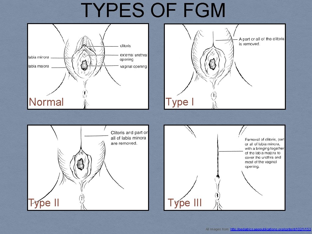 TYPES OF FGM Normal Type III All Images from: http: //pediatrics. aappublications. org/content/102/1/153 