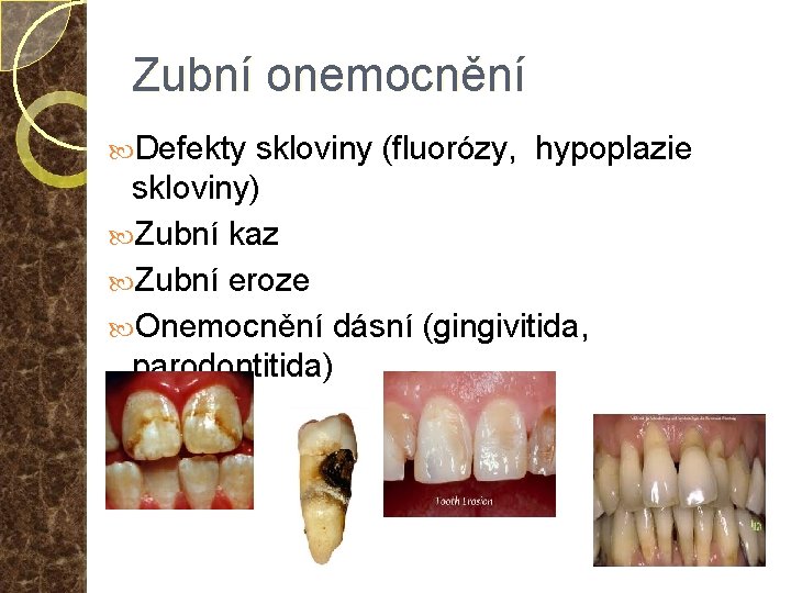 Zubní onemocnění Defekty skloviny (fluorózy, hypoplazie skloviny) Zubní kaz Zubní eroze Onemocnění dásní (gingivitida,