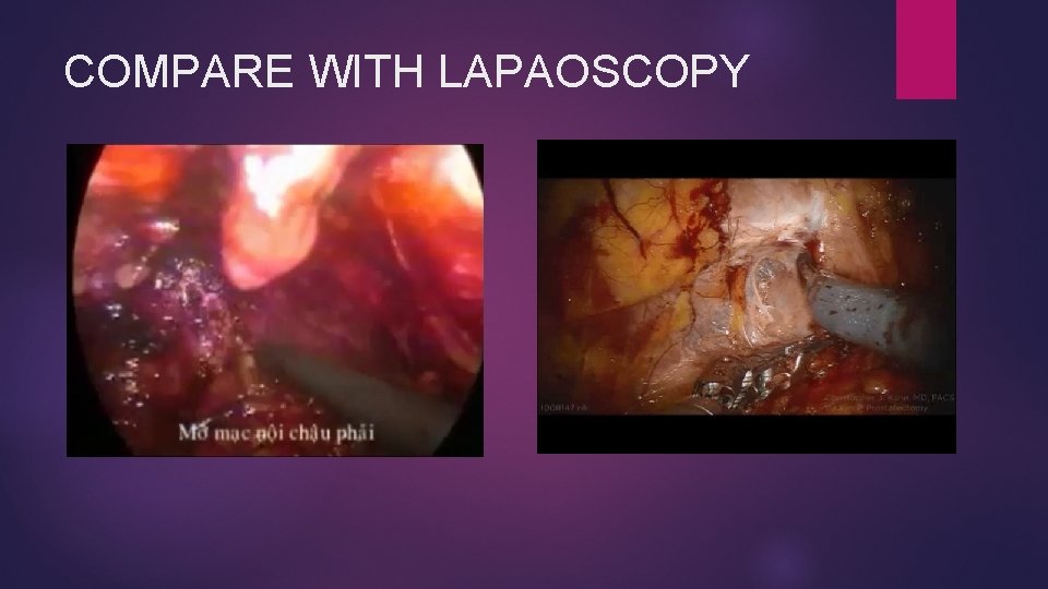 COMPARE WITH LAPAOSCOPY 