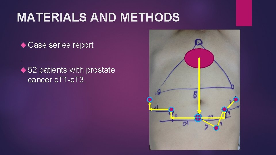 MATERIALS AND METHODS Case series report . 52 patients with prostate cancer c. T