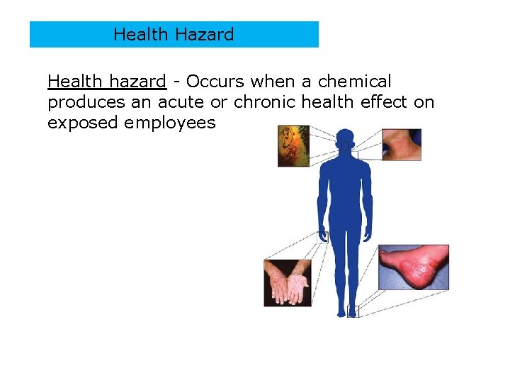 Health Hazard Health hazard - Occurs when a chemical produces an acute or chronic