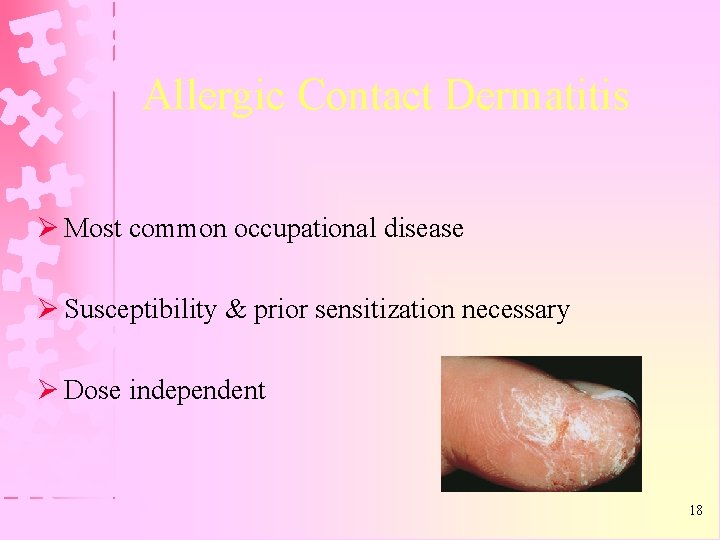 Allergic Contact Dermatitis Ø Most common occupational disease Ø Susceptibility & prior sensitization necessary