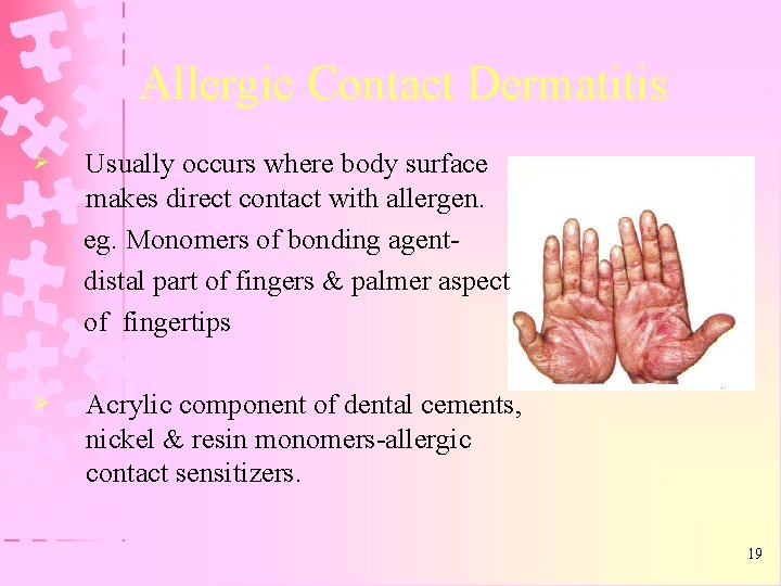Allergic Contact Dermatitis Ø Usually occurs where body surface makes direct contact with allergen.