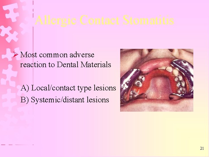 Allergic Contact Stomatitis Ø Most common adverse reaction to Dental Materials A) Local/contact type